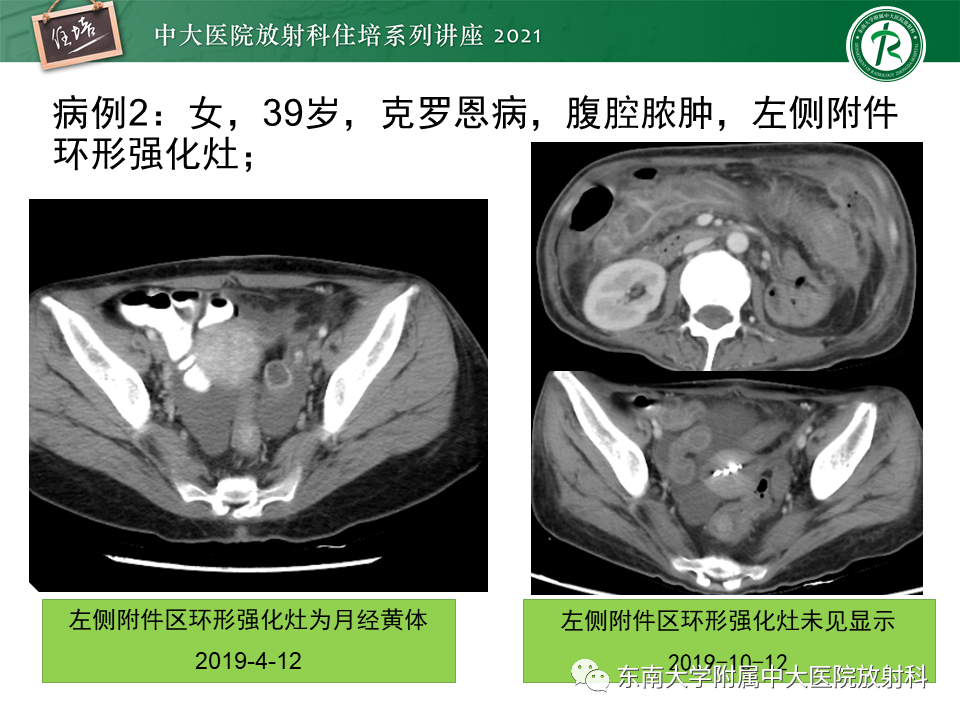 影像PPT - 【PPT】卵巢黄体及相关疾病诊断及鉴别-37