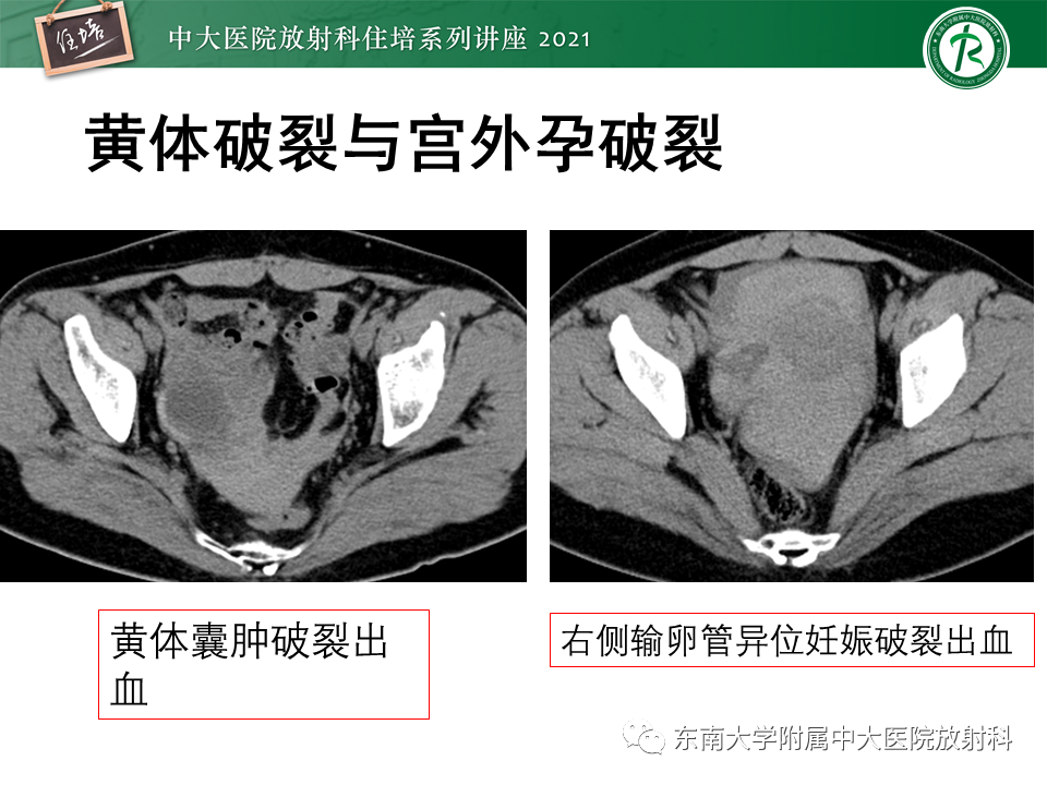 影像PPT - 【PPT】卵巢黄体及相关疾病诊断及鉴别-31
