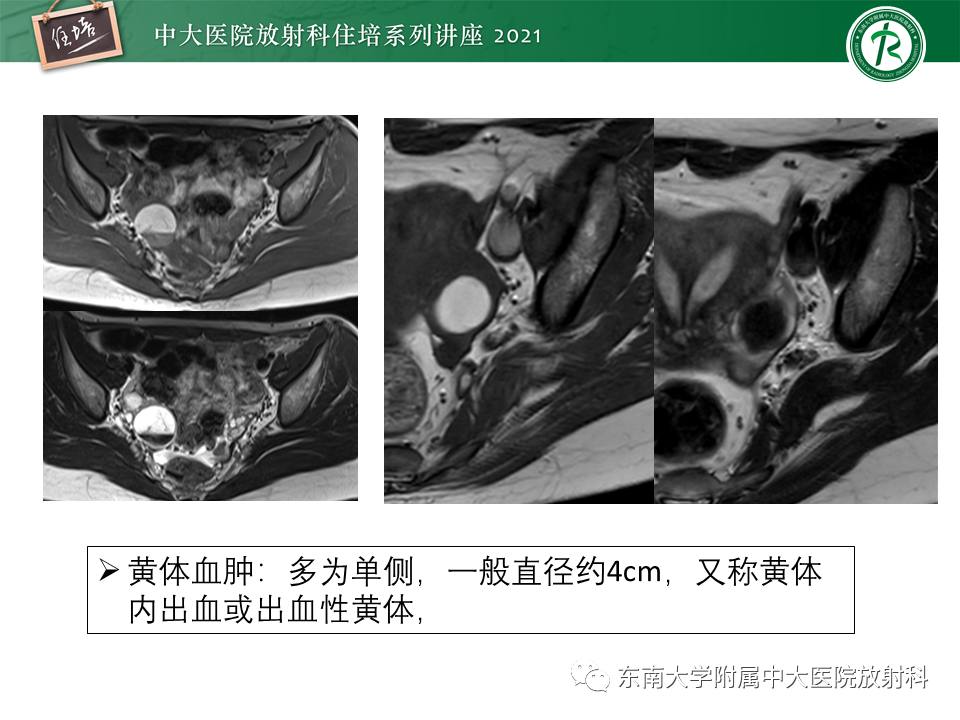 影像PPT - 【PPT】卵巢黄体及相关疾病诊断及鉴别-35