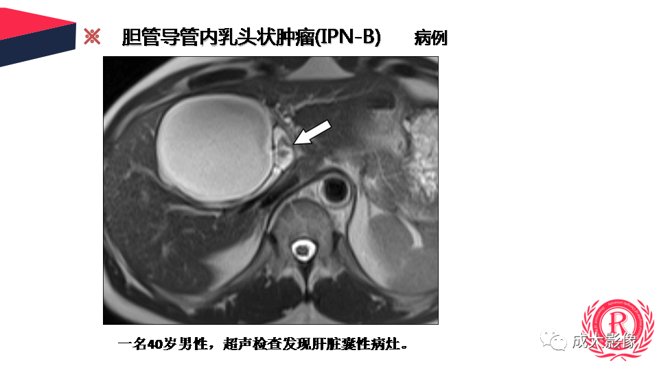 影像PPT - 【PPT】罕见的胆道肿瘤的影像表现-16