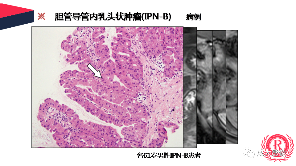 影像PPT - 【PPT】罕见的胆道肿瘤的影像表现-13