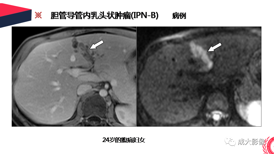 影像PPT - 【PPT】罕见的胆道肿瘤的影像表现-19