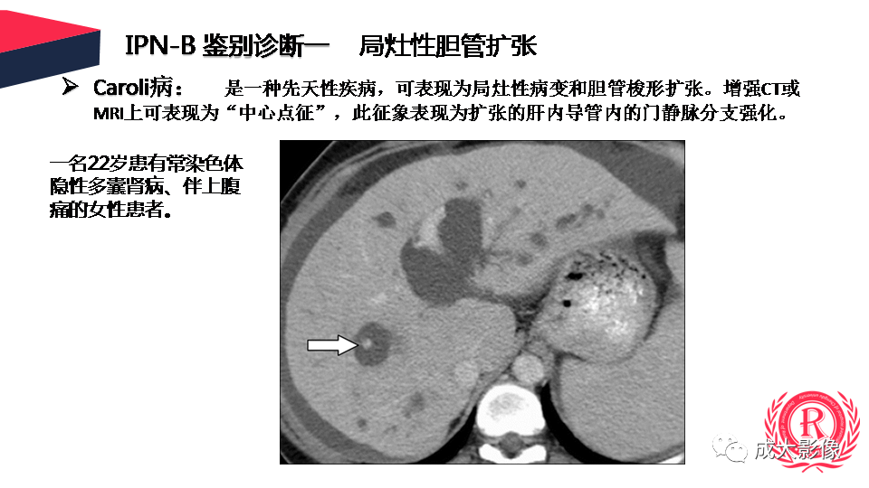 影像PPT - 【PPT】罕见的胆道肿瘤的影像表现-24