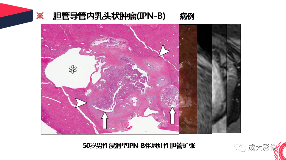 影像PPT - 【PPT】罕见的胆道肿瘤的影像表现-18