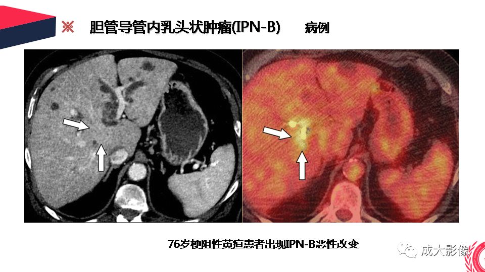 影像PPT - 【PPT】罕见的胆道肿瘤的影像表现-20