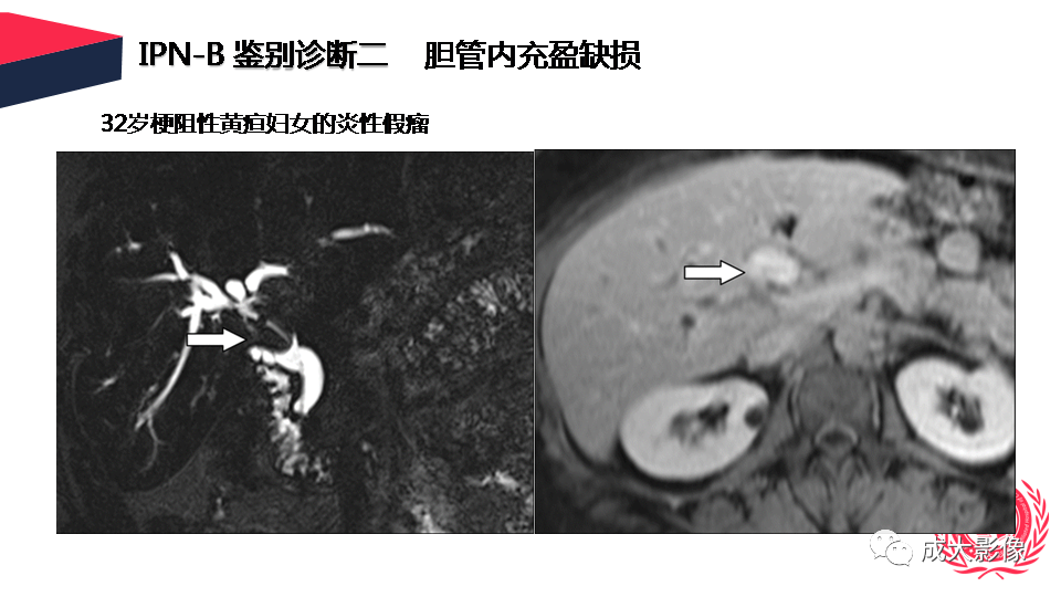 影像PPT - 【PPT】罕见的胆道肿瘤的影像表现-28