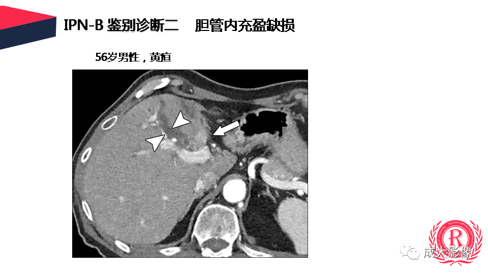 影像PPT - 【PPT】罕见的胆道肿瘤的影像表现-30
