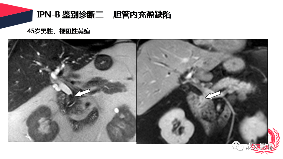 影像PPT - 【PPT】罕见的胆道肿瘤的影像表现-31