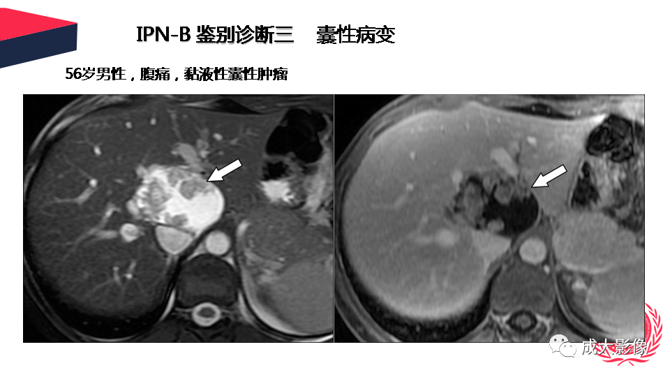 影像PPT - 【PPT】罕见的胆道肿瘤的影像表现-33