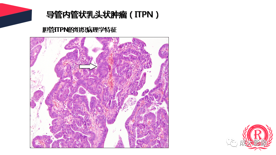 影像PPT - 【PPT】罕见的胆道肿瘤的影像表现-36