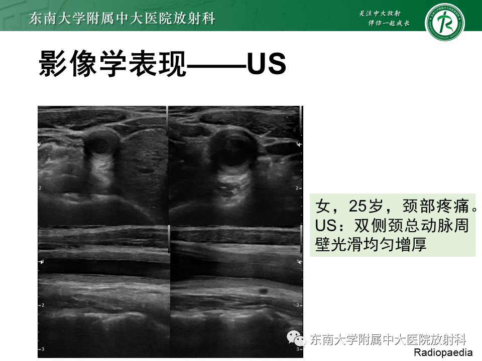 影像PPT - 【PPT】系统性血管炎-14