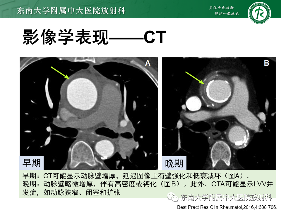 影像PPT - 【PPT】系统性血管炎-15