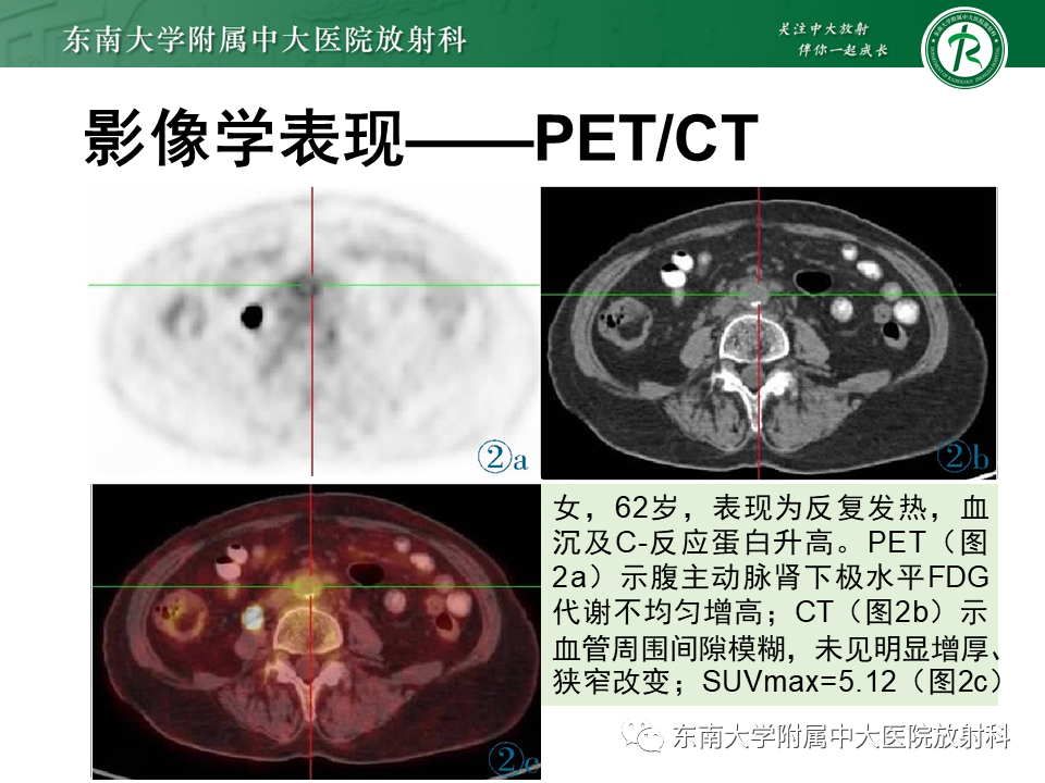影像PPT - 【PPT】系统性血管炎-17