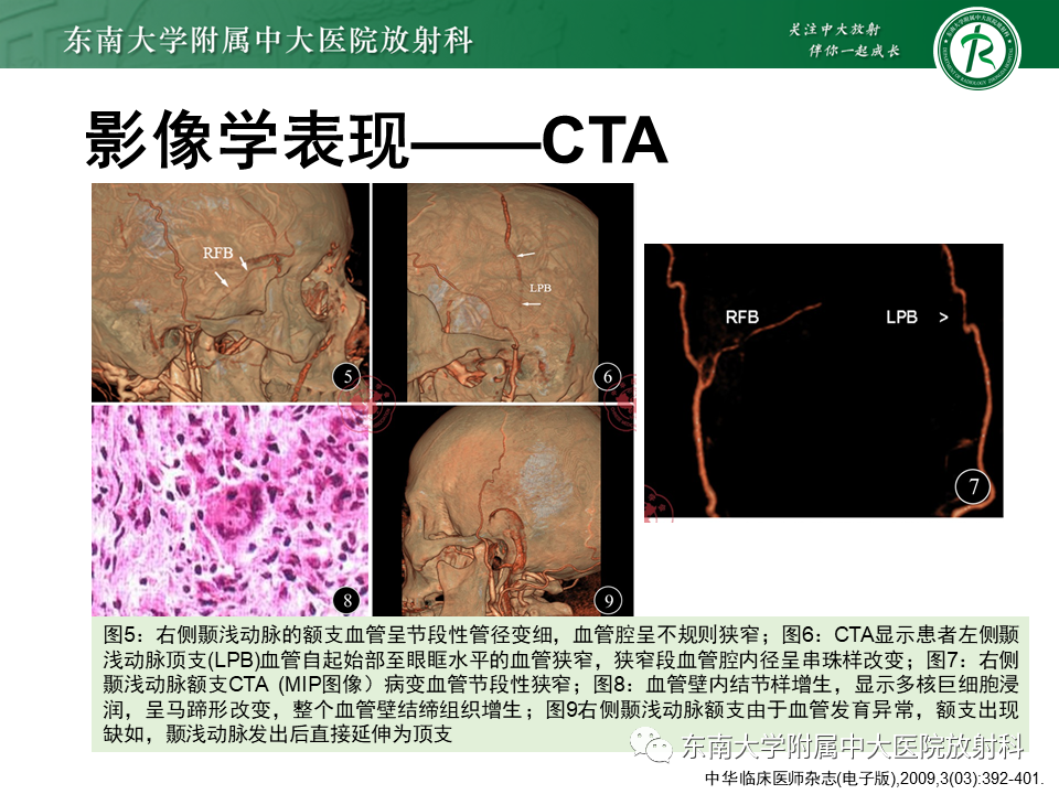 影像PPT - 【PPT】系统性血管炎-22