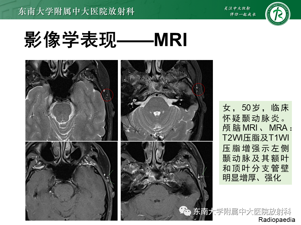 影像PPT - 【PPT】系统性血管炎-23