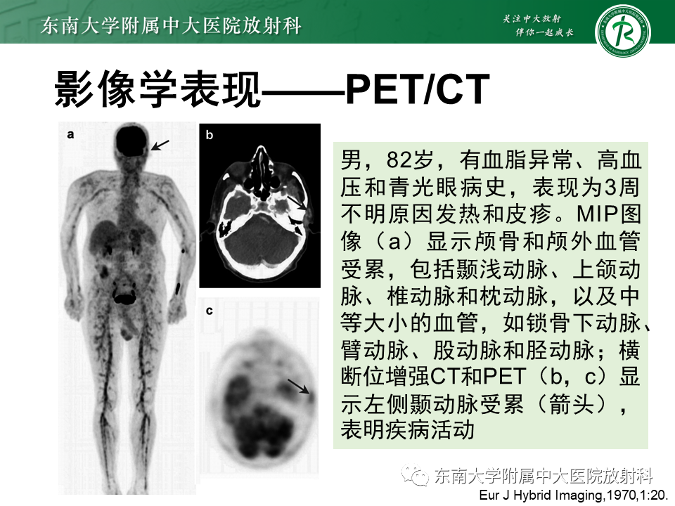 影像PPT - 【PPT】系统性血管炎-24