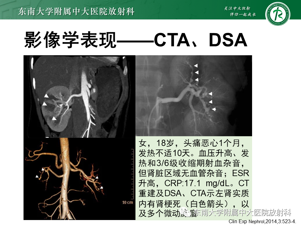 影像PPT - 【PPT】系统性血管炎-30
