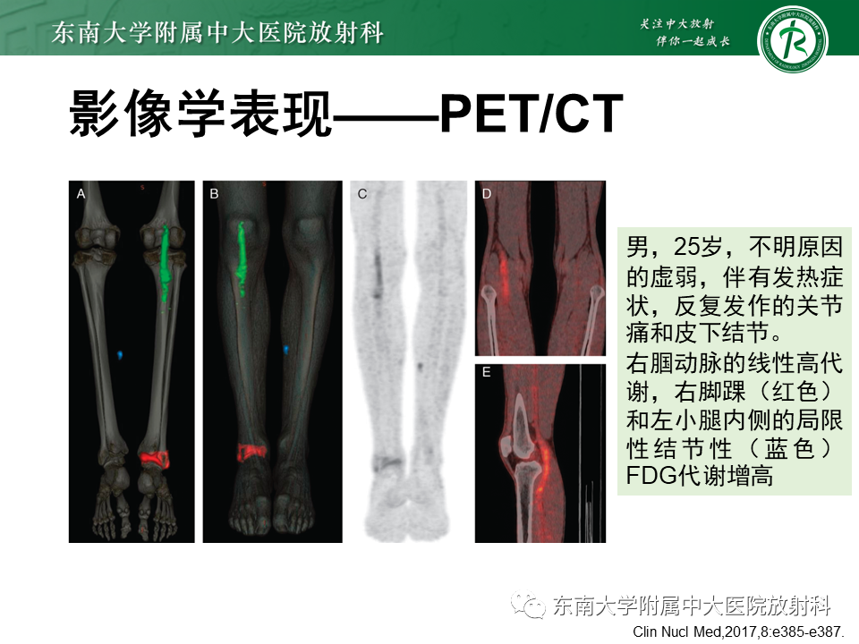 影像PPT - 【PPT】系统性血管炎-31