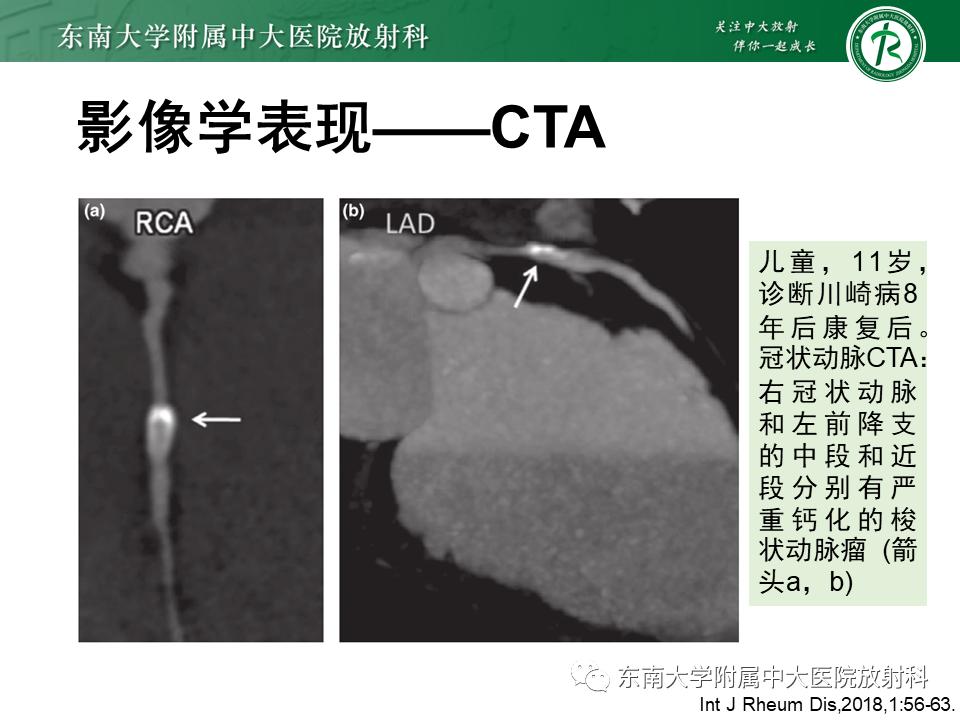 影像PPT - 【PPT】系统性血管炎-34