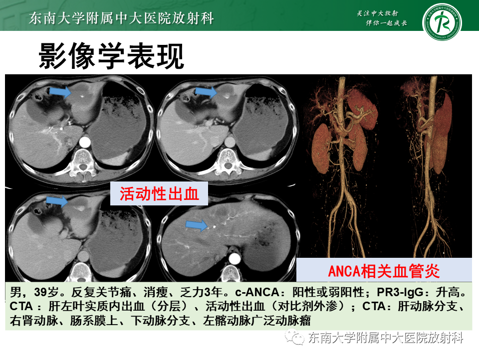 影像PPT - 【PPT】系统性血管炎-38