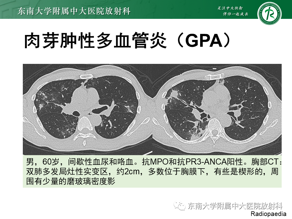 影像PPT - 【PPT】系统性血管炎-40