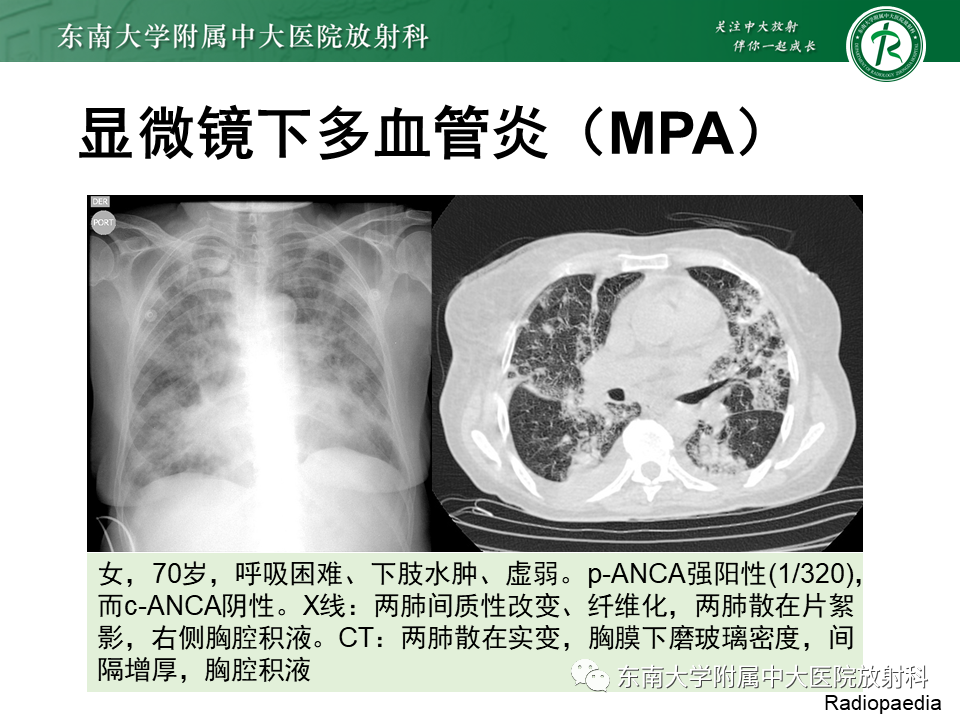 影像PPT - 【PPT】系统性血管炎-39