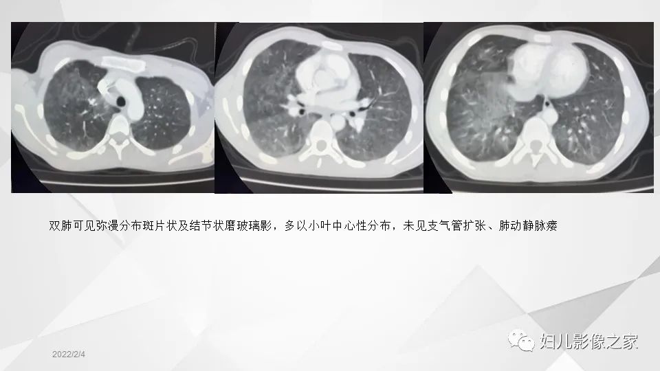 影像PPT - 【PPT】儿童特发性肺含铁血黄素沉积症的影像表现-10