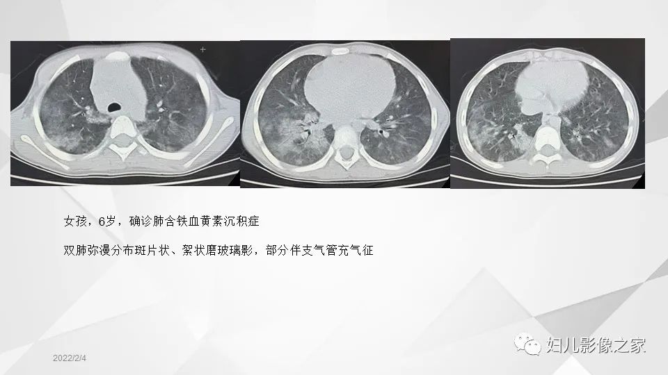 影像PPT - 【PPT】儿童特发性肺含铁血黄素沉积症的影像表现-12