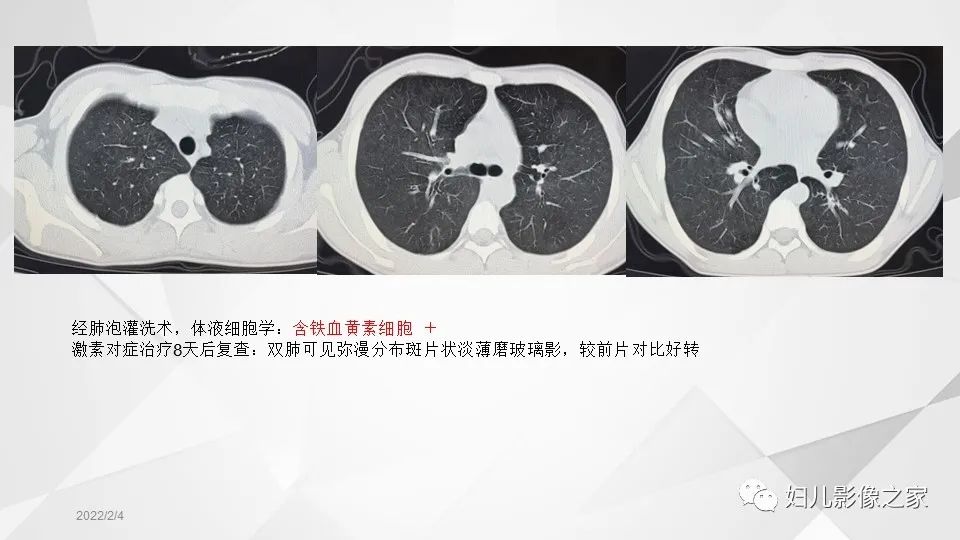 影像PPT - 【PPT】儿童特发性肺含铁血黄素沉积症的影像表现-11