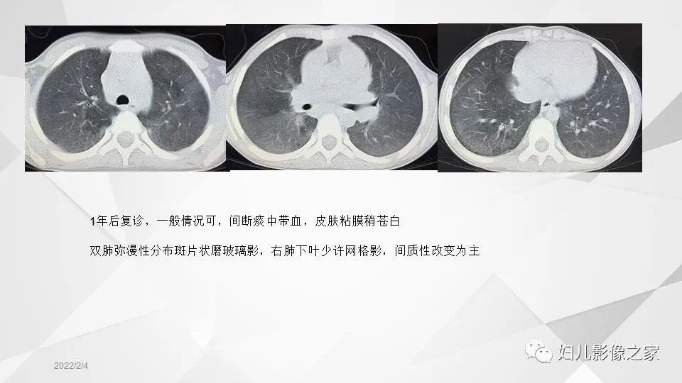 影像PPT - 【PPT】儿童特发性肺含铁血黄素沉积症的影像表现-13