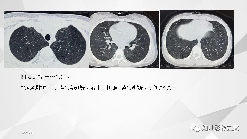 影像PPT - 【PPT】儿童特发性肺含铁血黄素沉积症的影像表现-14