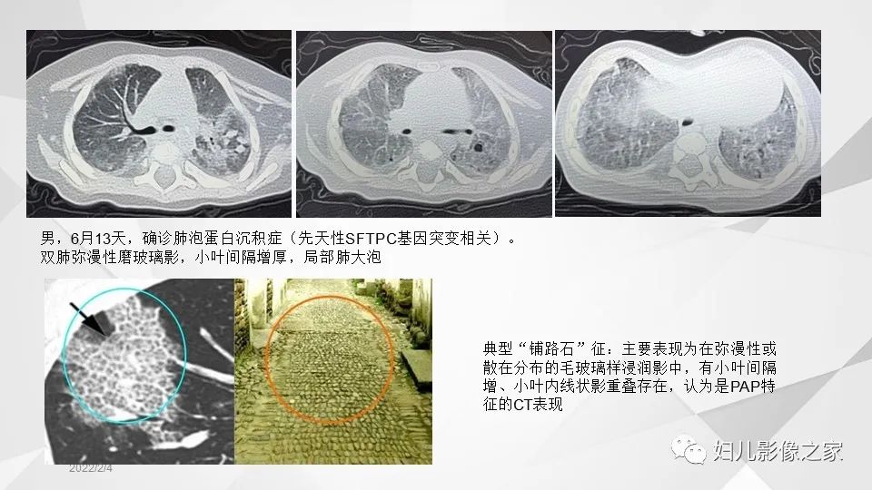 影像PPT - 【PPT】儿童特发性肺含铁血黄素沉积症的影像表现-17