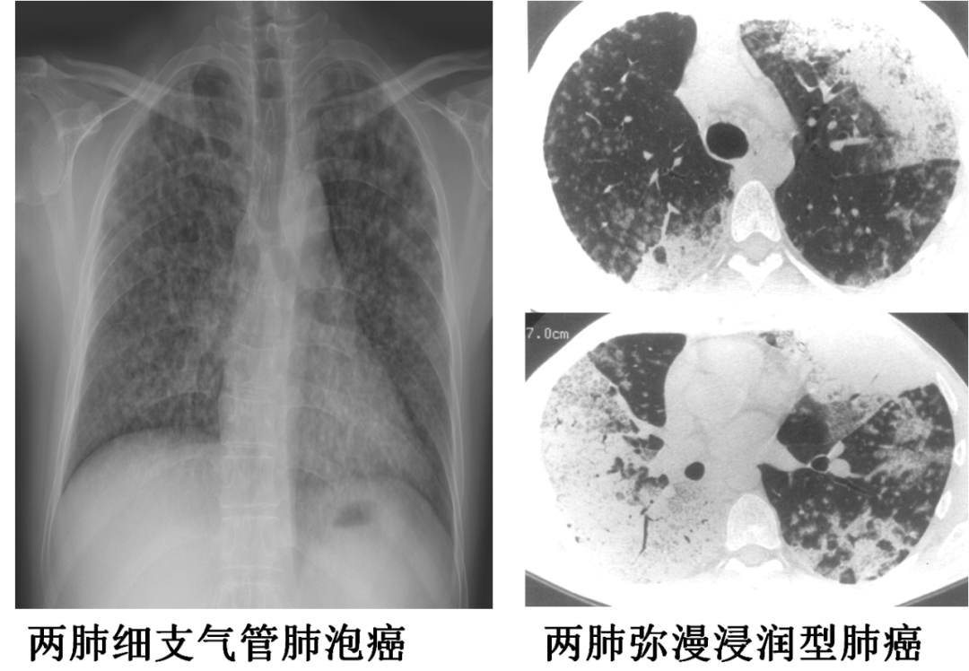 影像PPT - 肺弥漫结节疾病的 CT 影像学表现-1 影像PPT - 肺弥漫结节疾病的 CT 影像学表现-1