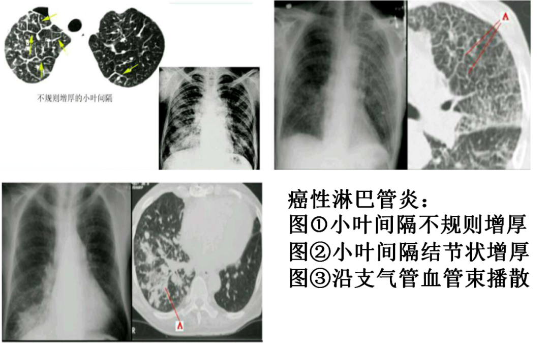 影像PPT - 肺弥漫结节疾病的 CT 影像学表现-2 影像PPT - 肺弥漫结节疾病的 CT 影像学表现-2