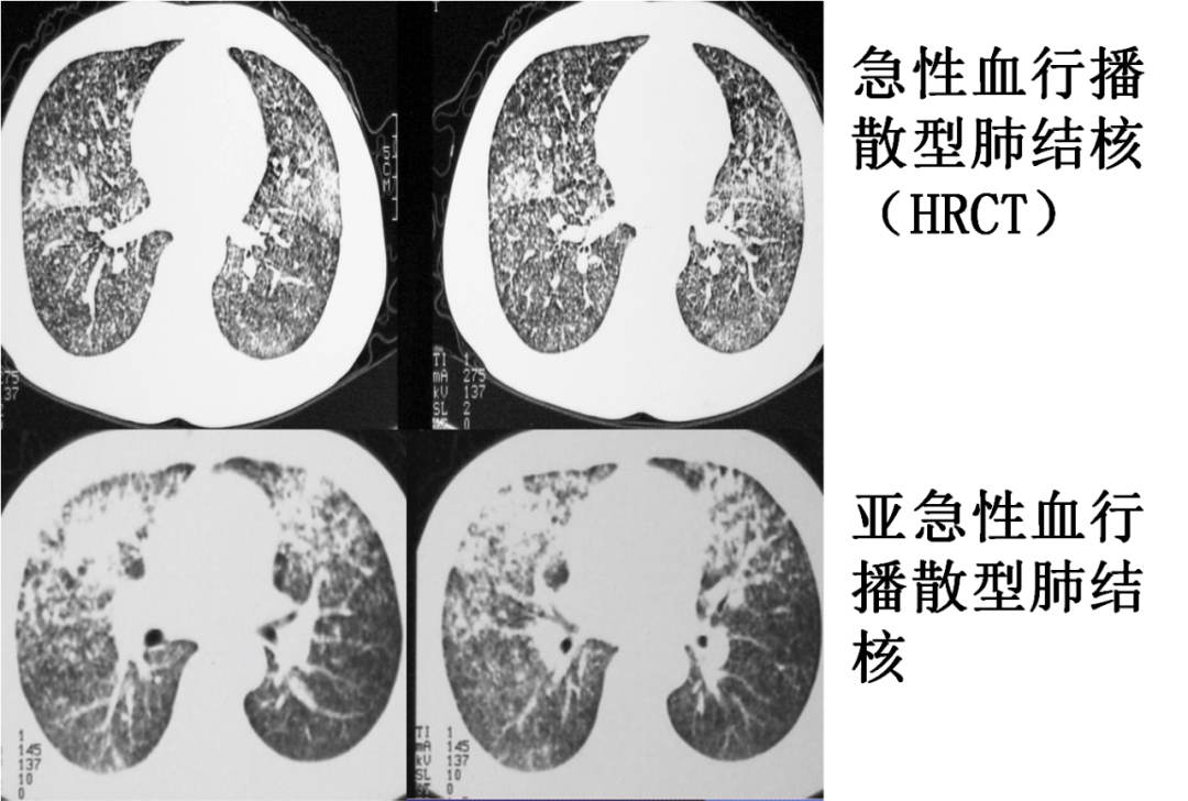 影像PPT - 肺弥漫结节疾病的 CT 影像学表现-3 影像PPT - 肺弥漫结节疾病的 CT 影像学表现-3
