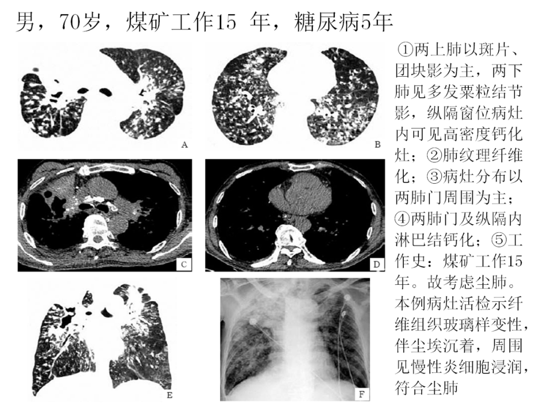 影像PPT - 肺弥漫结节疾病的 CT 影像学表现-5 影像PPT - 肺弥漫结节疾病的 CT 影像学表现-5