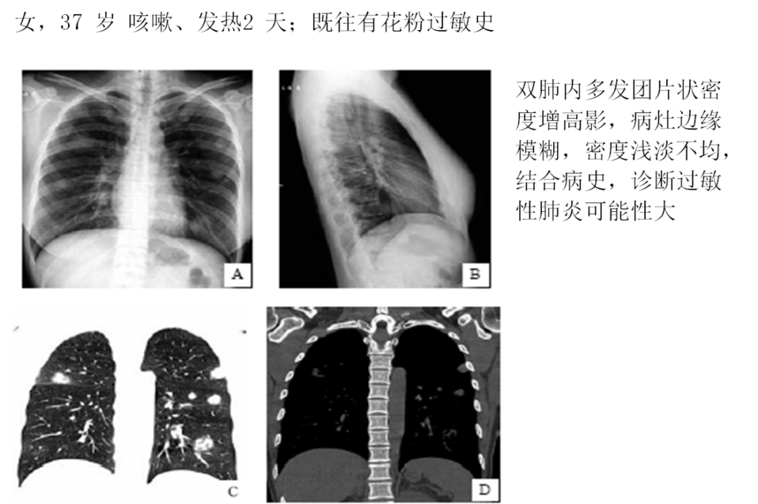 影像PPT - 肺弥漫结节疾病的 CT 影像学表现-6 影像PPT - 肺弥漫结节疾病的 CT 影像学表现-6
