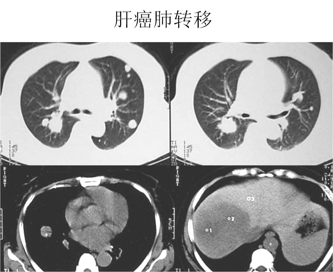 影像PPT - 肺弥漫结节疾病的 CT 影像学表现-7 影像PPT - 肺弥漫结节疾病的 CT 影像学表现-7