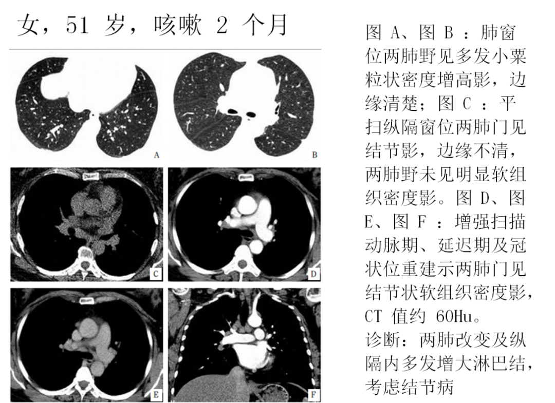 影像PPT - 肺弥漫结节疾病的 CT 影像学表现-9 影像PPT - 肺弥漫结节疾病的 CT 影像学表现-9