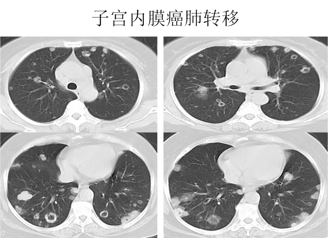 影像PPT - 肺弥漫结节疾病的 CT 影像学表现-8 影像PPT - 肺弥漫结节疾病的 CT 影像学表现-8