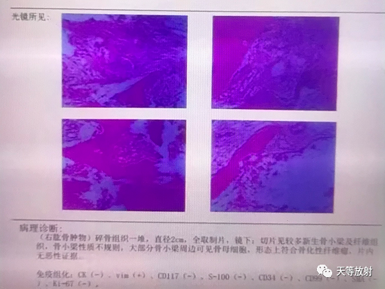 影像PPT - 长骨骨化性纤维瘤-5
