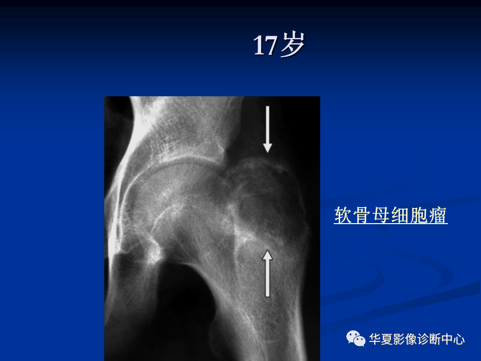 影像PPT - 【PPT】骨肿瘤影像诊断思路-40