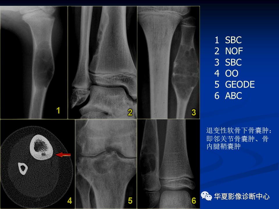 影像PPT - 【PPT】骨肿瘤影像诊断思路-41