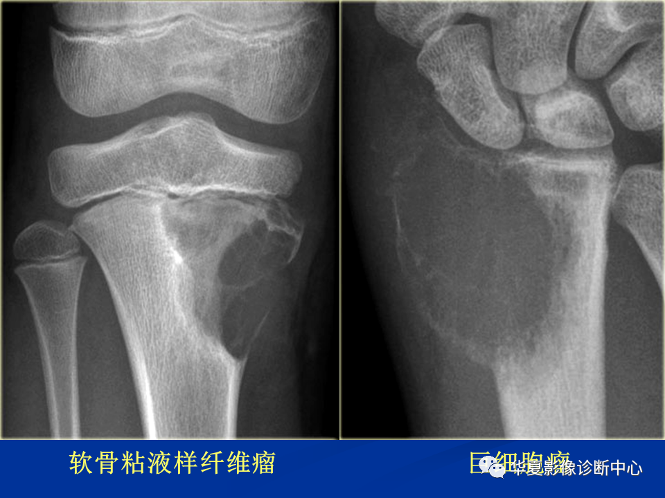 影像PPT - 【PPT】骨肿瘤影像诊断思路-45