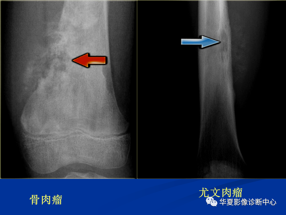 影像PPT - 【PPT】骨肿瘤影像诊断思路-46