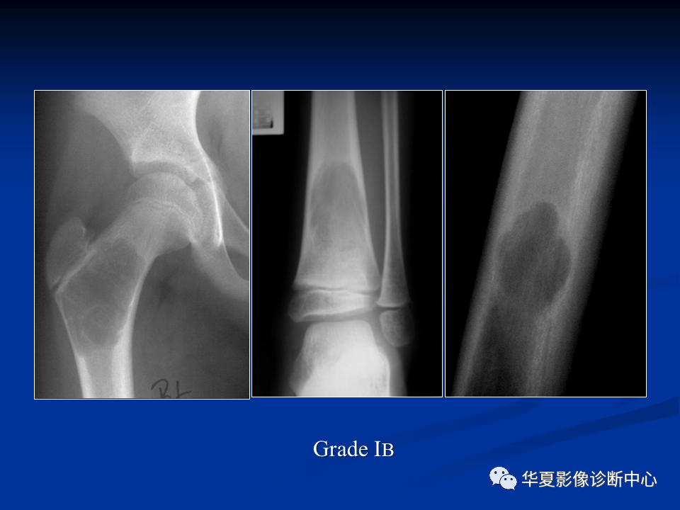 影像PPT - 【PPT】骨肿瘤影像诊断思路-50