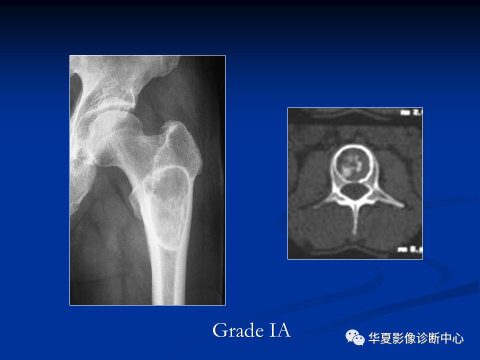 影像PPT - 【PPT】骨肿瘤影像诊断思路-49