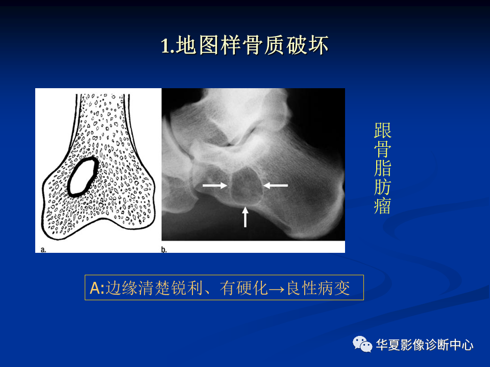 影像PPT - 【PPT】骨肿瘤影像诊断思路-54
