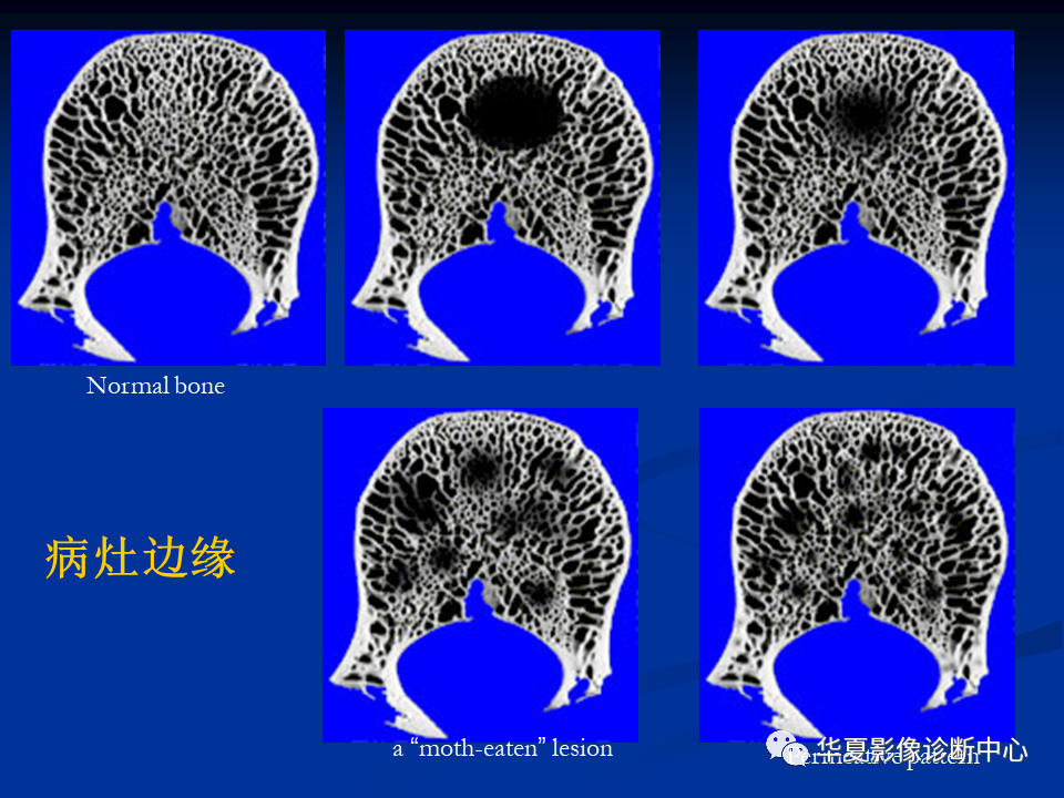 影像PPT - 【PPT】骨肿瘤影像诊断思路-53