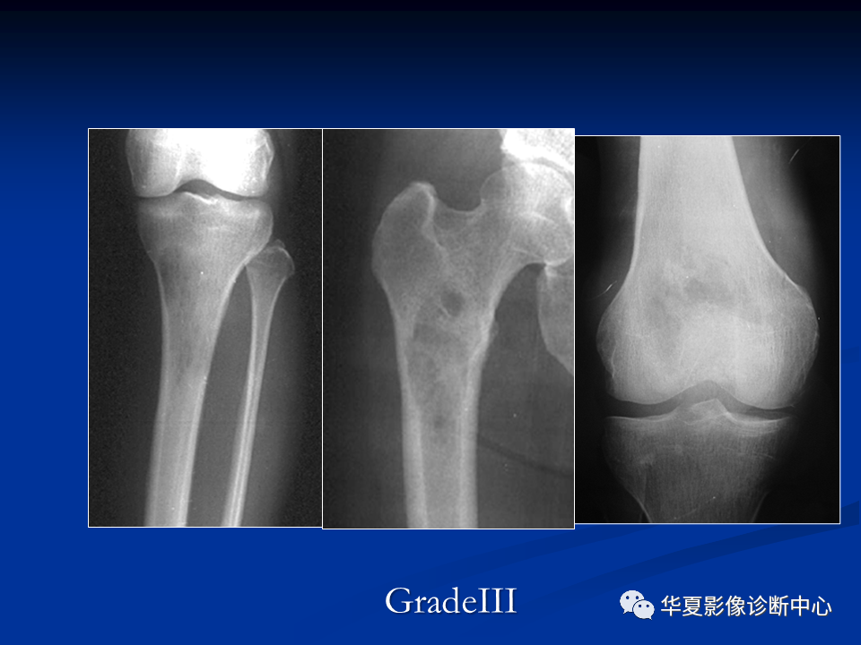 影像PPT - 【PPT】骨肿瘤影像诊断思路-52